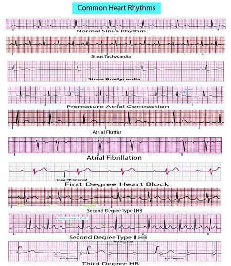 ecg porn|ecg Search